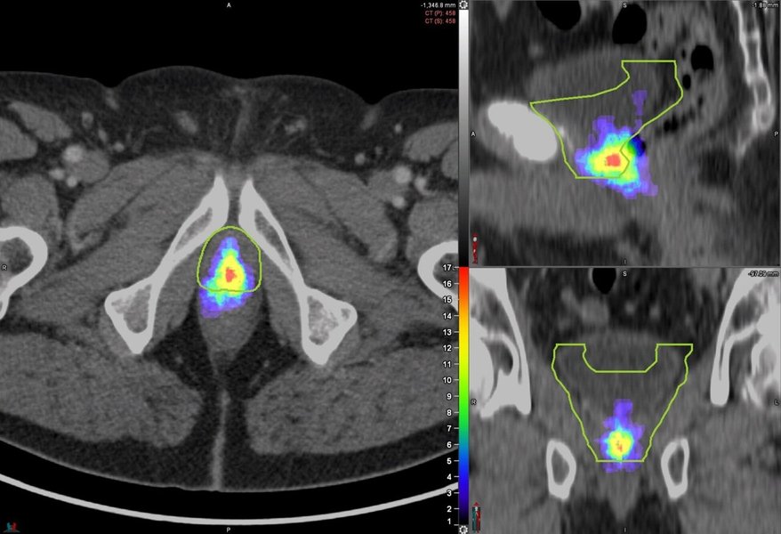 A scientific image showing a PSMA PET scan used for prostate cancer imaging.