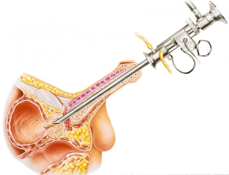 prostatectomy-parkinsons-disease-outcomes-e38cstph