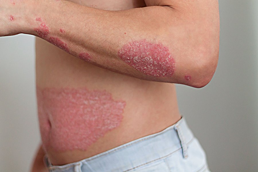 psoriasis-definition-treatment-management-5vgk7ca1