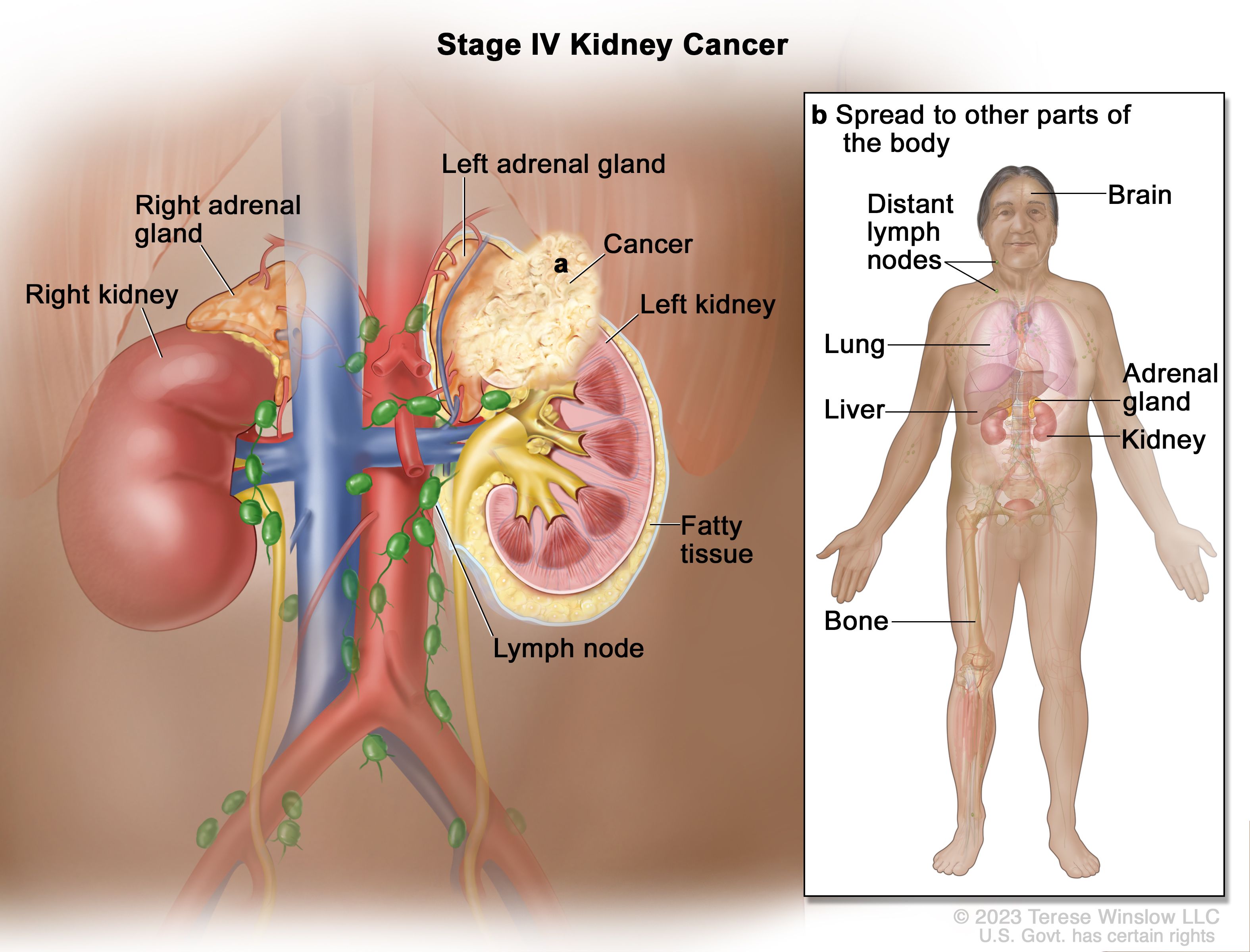 renal cell carcinoma clinic