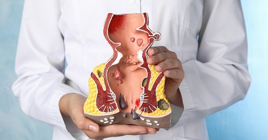 minimally invasive hemorrhoid recovery