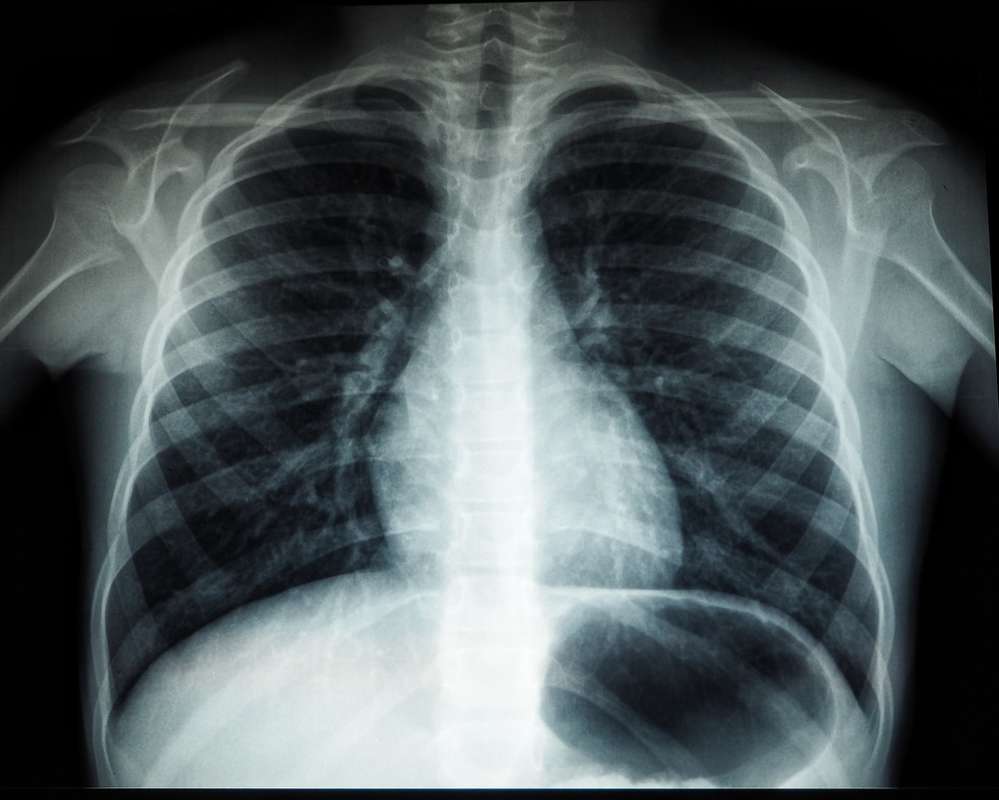 lungs, chest x ray, pulmonary therapy, respiratory care