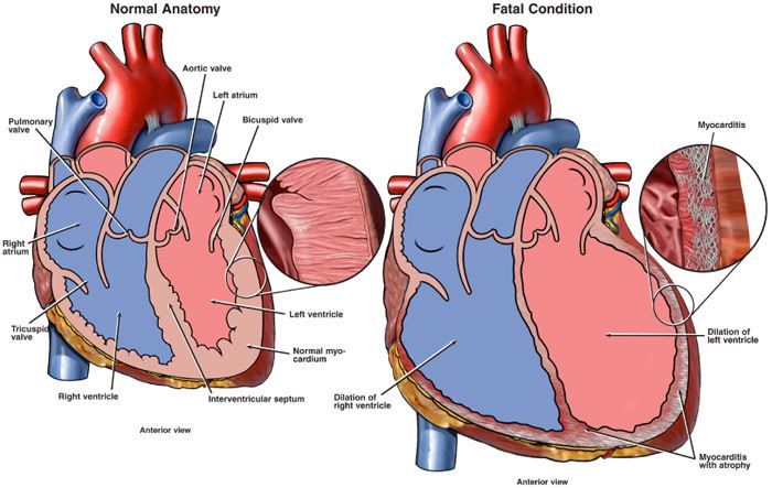heart inflammation medical illustration
