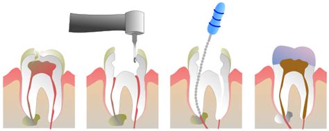 root canal procedure dental