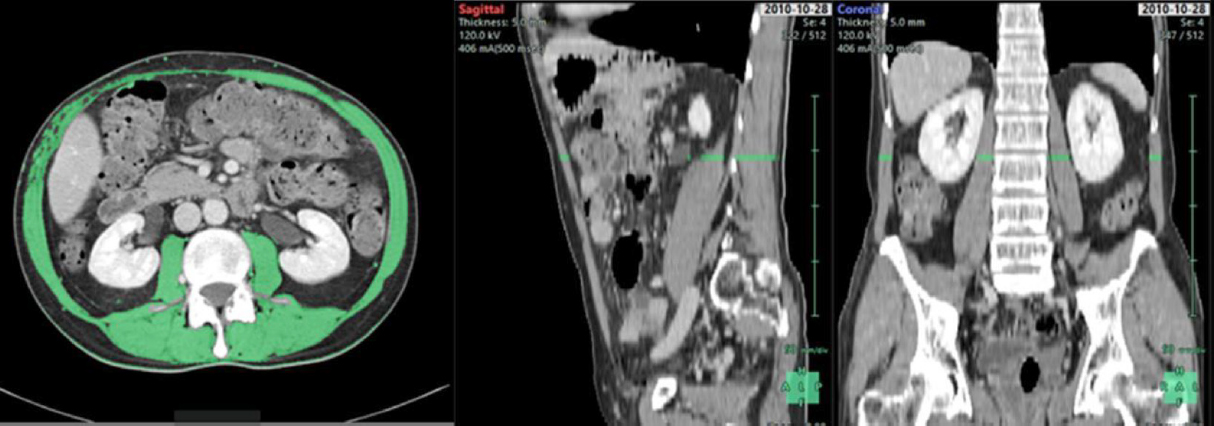 liver cirrhosis muscle scan