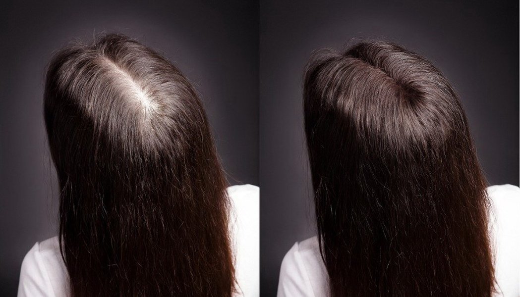 scalp-mesotherapy-cocktail-composition-y3mq2hv0
