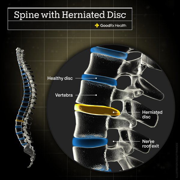 sciatica-pro-plus-reviews-b5c3npqy