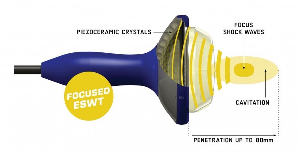 Diagram showing focused shockwaves targeting an affected area.