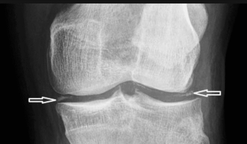 shockwave-therapy-pseudogout-research-e5lv1qut