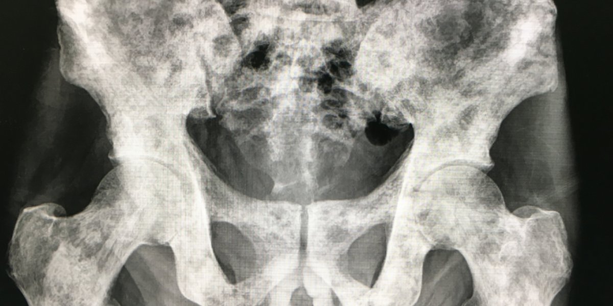 single-prostate-cancer-bone-metastasis-explained-xmtk851u