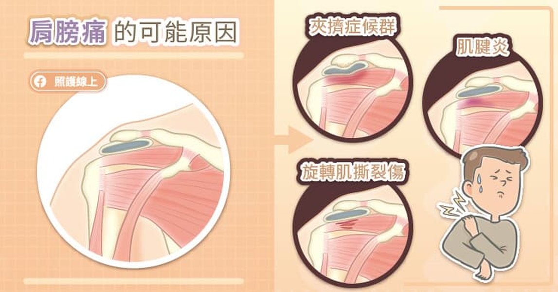 一張圖片顯示肩關節的解剖結構，包括肩峰、旋轉肌袖和肱骨頭，並標示出肩夾擠的位置。