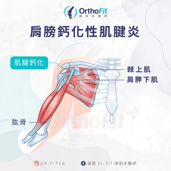 X光片顯示肩部有白色鈣化點，旁邊附有對鈣化性肌腱炎的解釋文字。