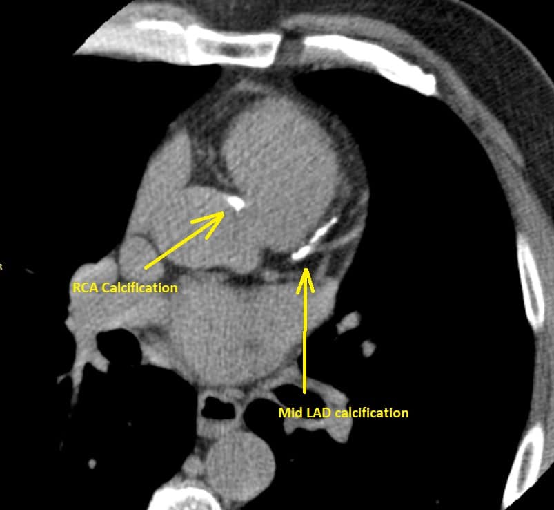 coronary artery calcification imaging