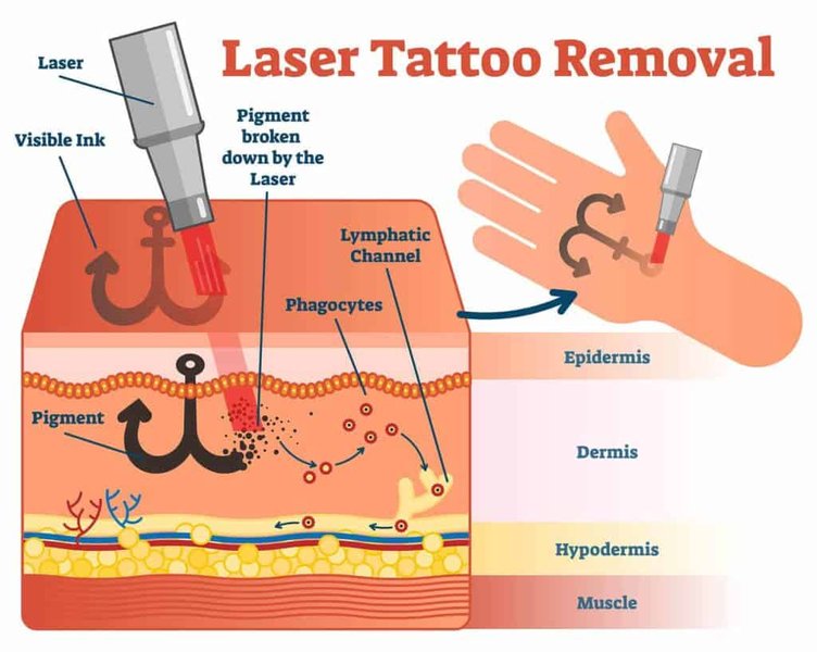 tattoo-removal-methods-guide-lg1utk2e