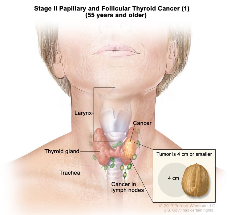 thyroid cancer treatment and neck rehabilitation