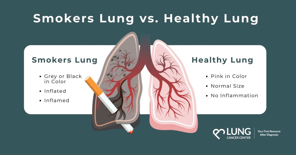tobacco-lung-cancer-risks-prevention-e43sjpgr