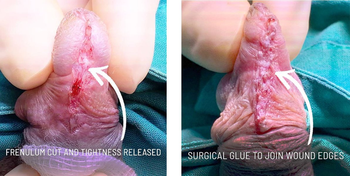 transparent-frenulum-removal-query-fa1f0in6