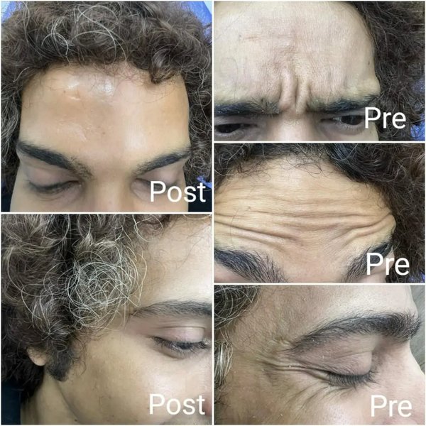 صورة تظهر نتائج حقن البوتوكس للتجاعيد