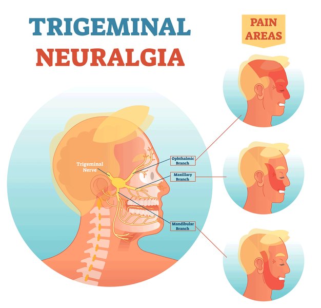 trigeminal-neuralgia-comprehensive-guide-bg3qteh0