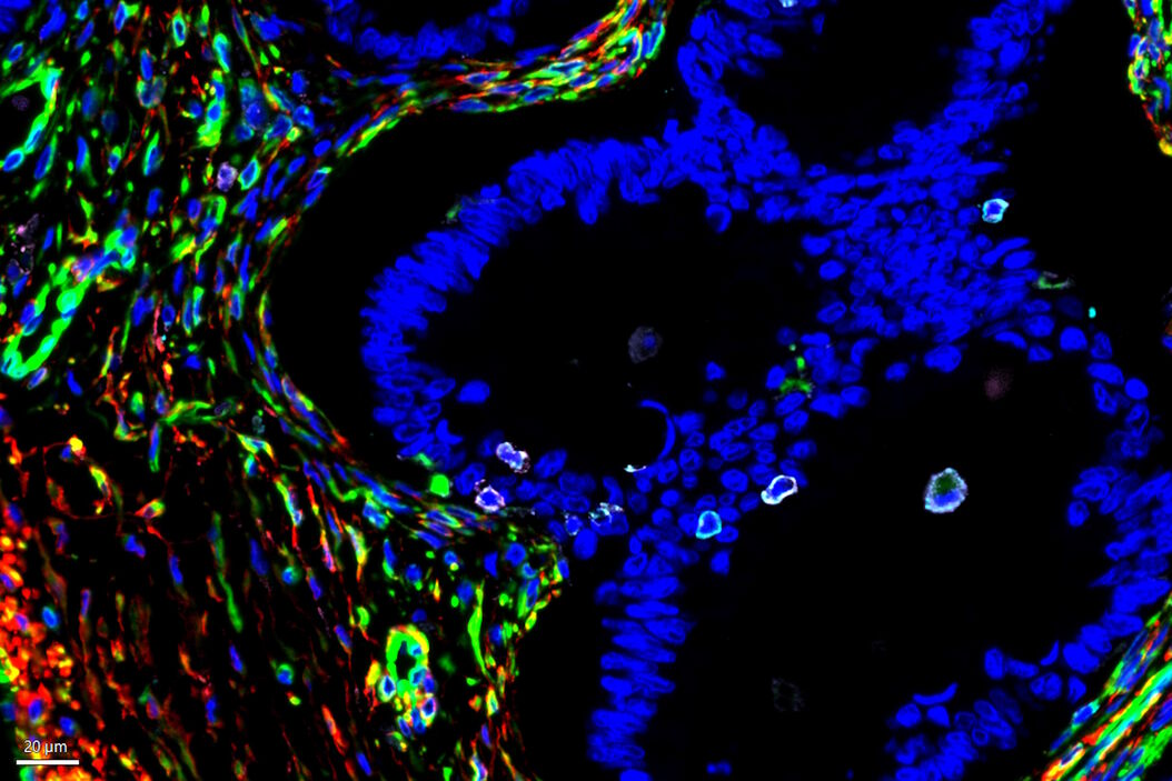 cancer cells under microscope tumor microenvironment