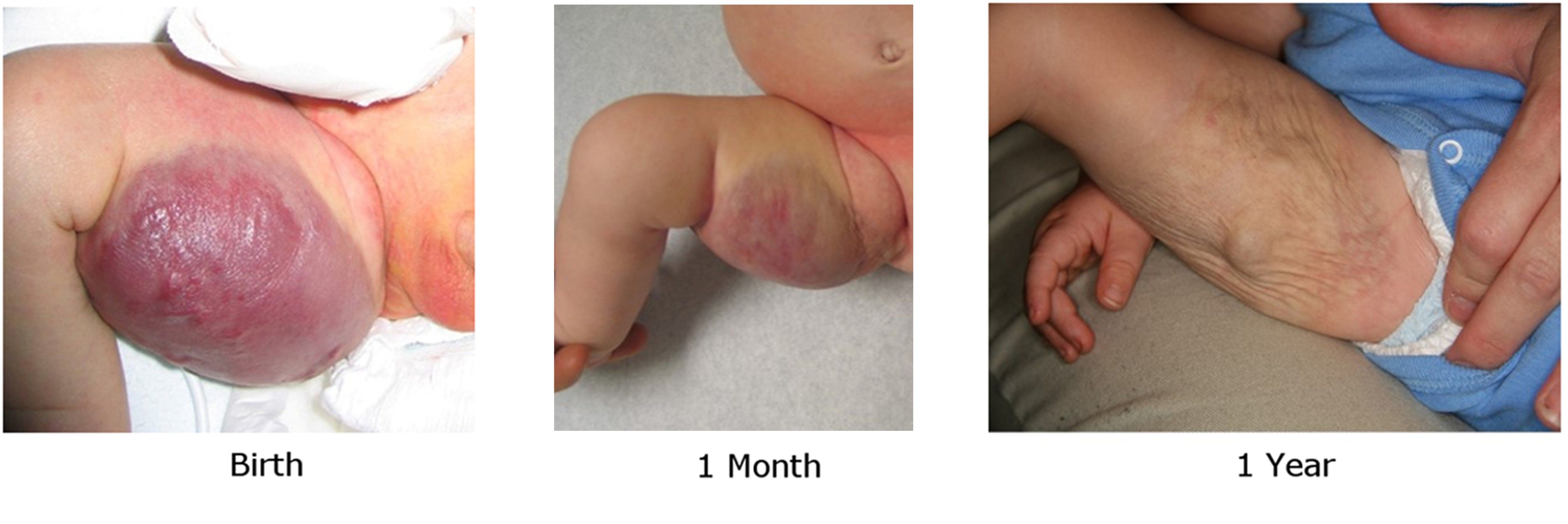 tumor vascular abnormalities