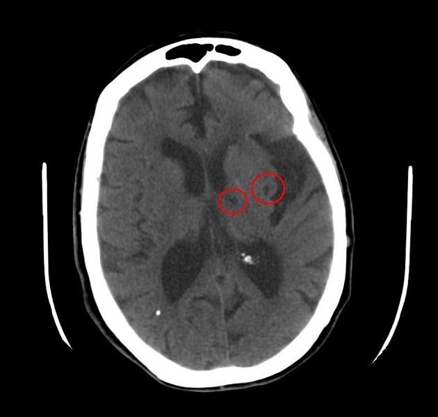 understanding-incidental-brain-lacunes-xcwd4wl7