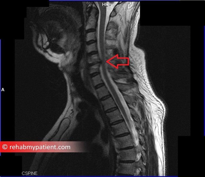 MRI showing cervical radiculopathy
