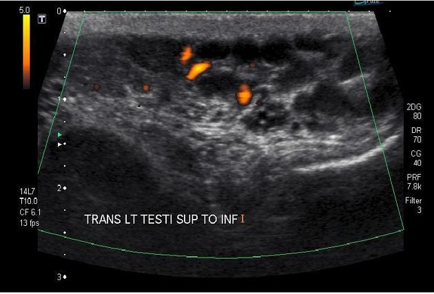 scrotum veins ultrasound diagnostic image