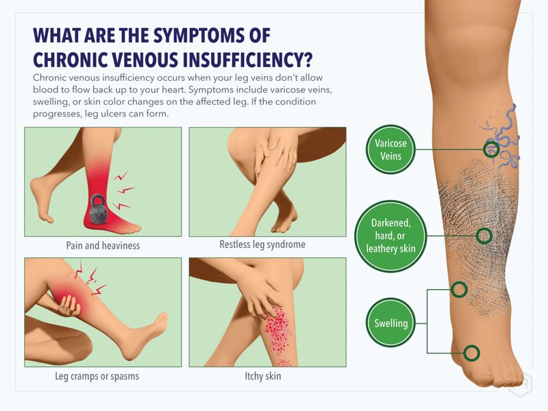 Diagram showing how compression garments aid venous return