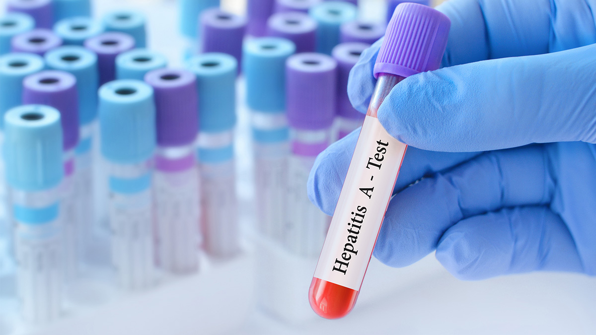 hepatitis virus test laboratory