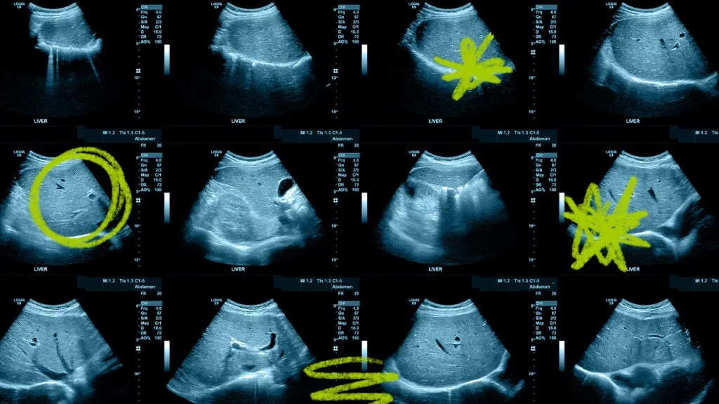 liver scan with vitamin supplements