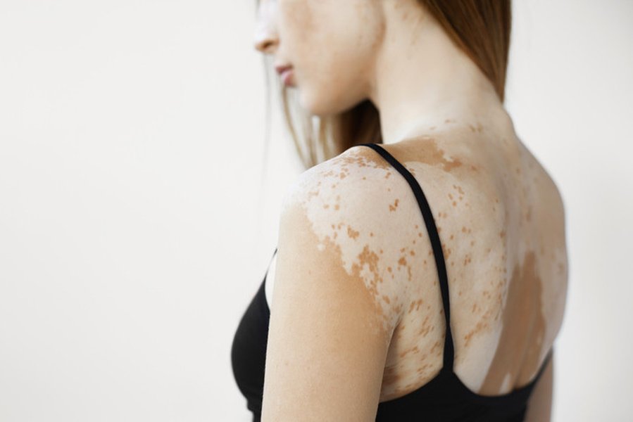 vitiligo-immune-dysregulation-autoimmune-b2slei6z