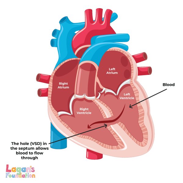 vsd-ventricular-septal-defect-explained-ysc7nid3