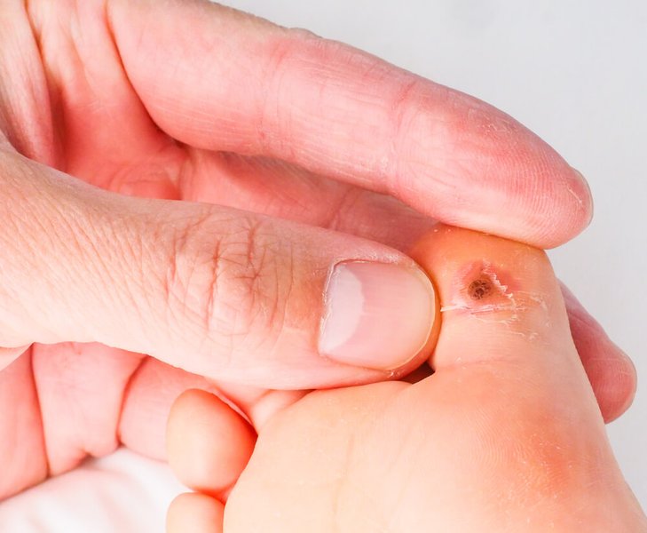 wart-removal-methods-guide-kcfvv9bj