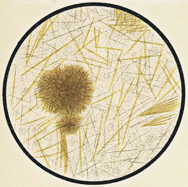 Microscopic image of uric acid crystals, which can form in joints and kidneys.