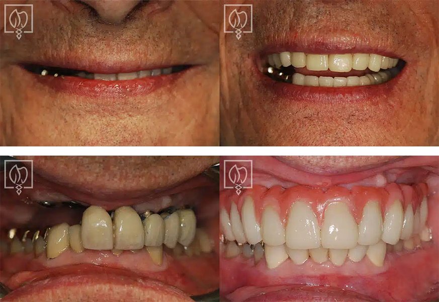 Before and after dental implant surgery