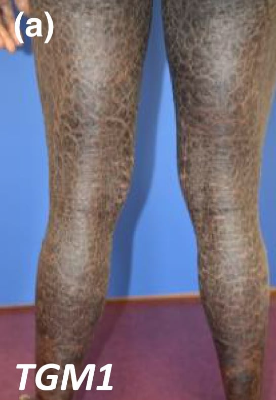 TGM1-nEDD: the large scales on the legs appear darker in a patient with a dark skin phototype compared with those seen in patients with lighter skin.