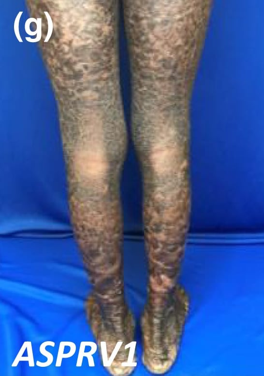 ASPRV1-nEDD: large lamellated scaling on the legs of a boy with skin of colour.