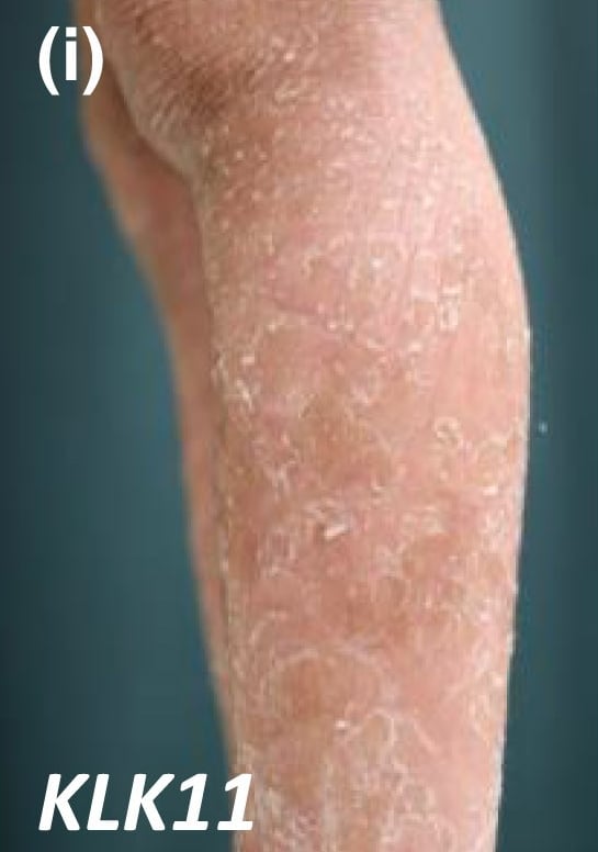 KLK11-nEDD: diffuse erythema with scaling on the lower leg.