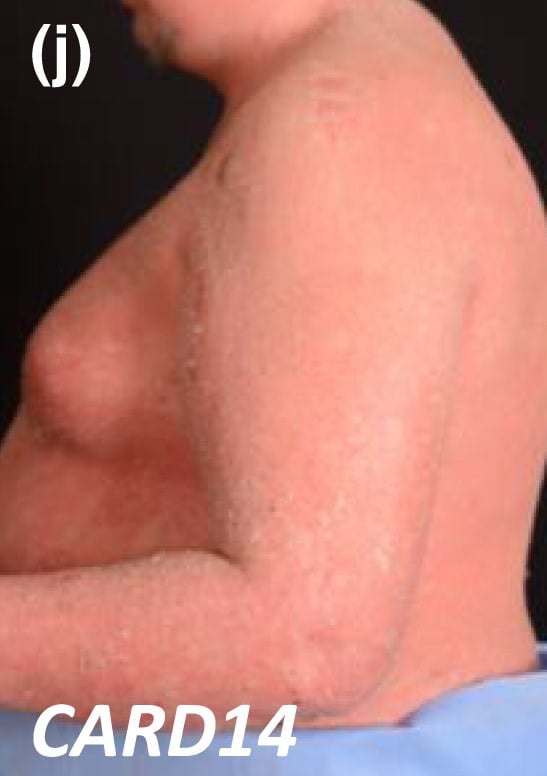 CARD14-nEDD: generalized scaling and erythema on the arm and the trunk.