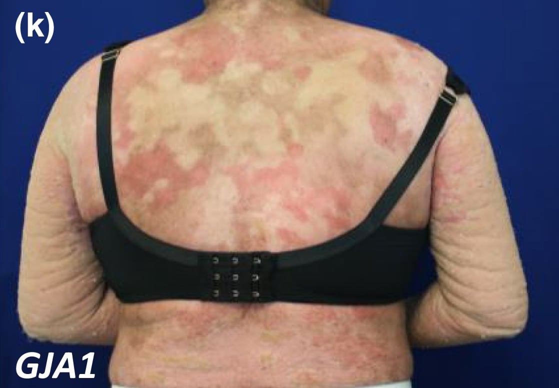 GJA1-nEDD: young woman with variable inflamed or hyperpigmented plaques.