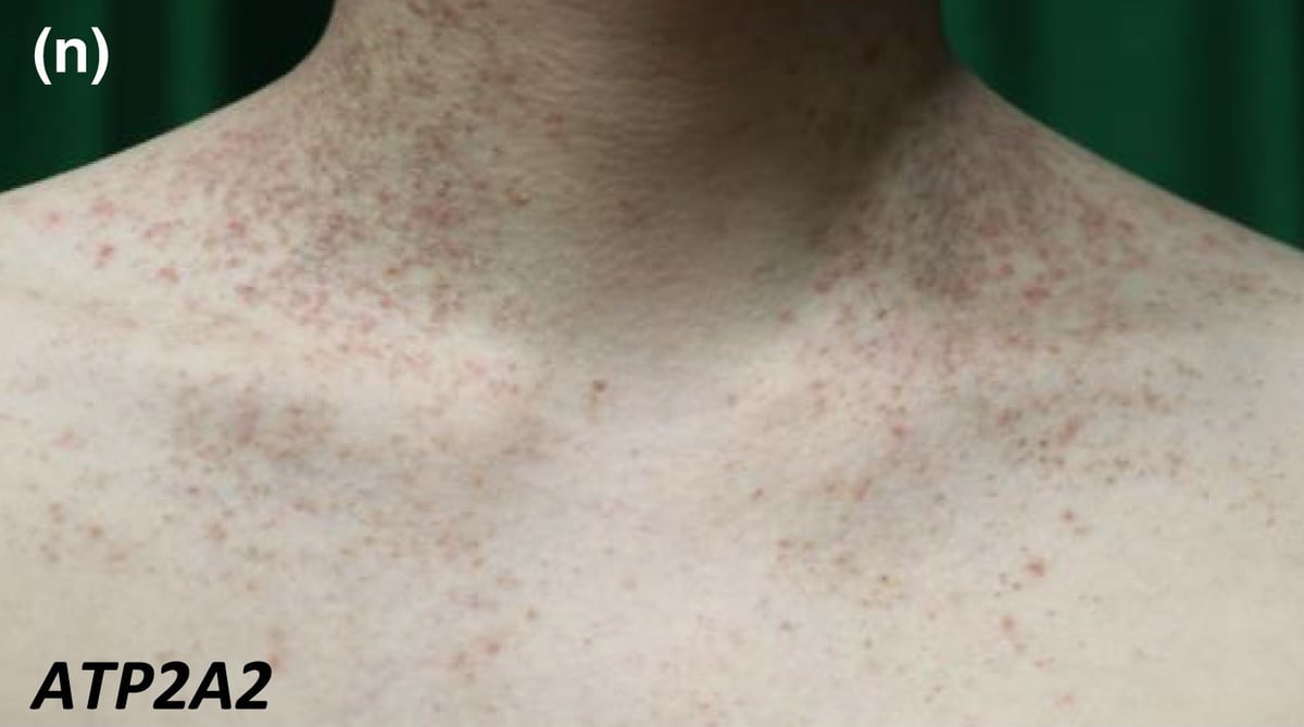 ATP2A2-nEDD: follicular keratotic papules coalescing into plaques on the neck.
