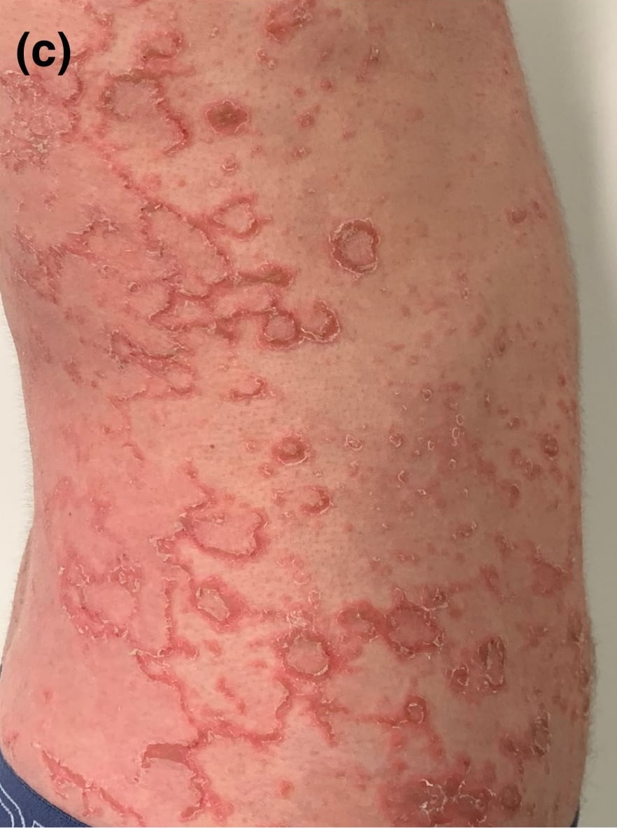 SPINK5-sEDD: Well-demarcated small pink plaques grouped in serpiginous configurations with distinctive scaling borders [ichthyosis linearis circumflexa (ILC)] in SPINK5-sEDD (ILC clinical subtype).