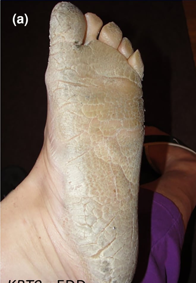 KRT9-pEDD: typical diffuse plantar keratoderma with fissuring.