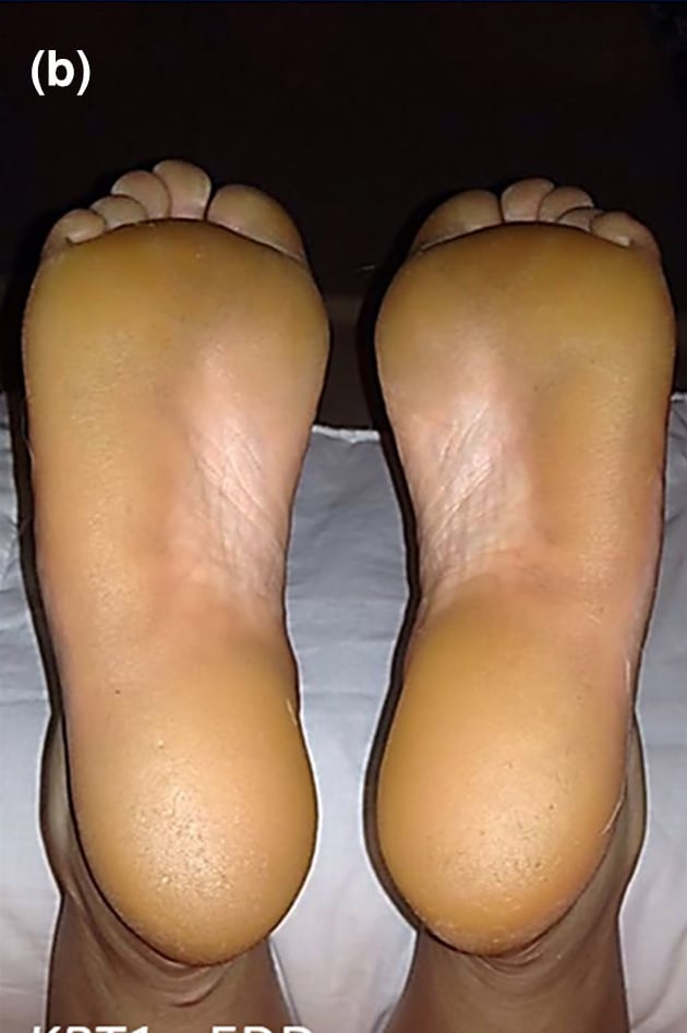 KRT1-pEDD: diffuse plantar keratoderma.