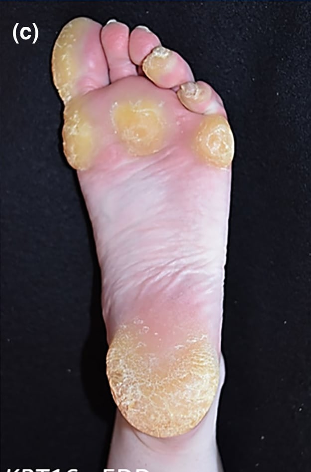 KRT16-pEDD: focal plantar calluses with surrounding erythema.