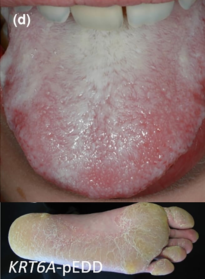 KRT6A-pEDD: oral leucokeratosis and focal plantar keratoderma.