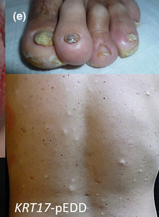 KRT17-pEDD: toenail dystrophy and steatocystomas on the back.