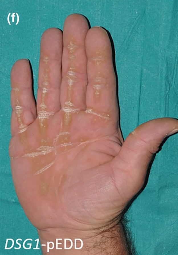 DSG1-pEDD: striate keratoderma on the palm.