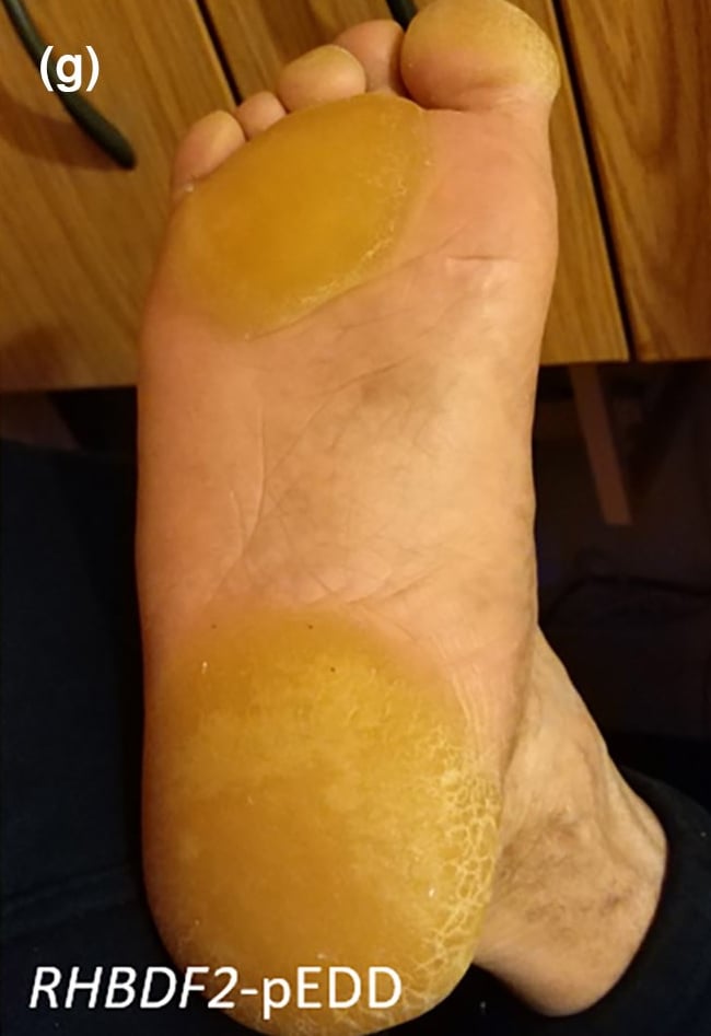 RHBDF2-pEDD: focal plantar keratoderma.